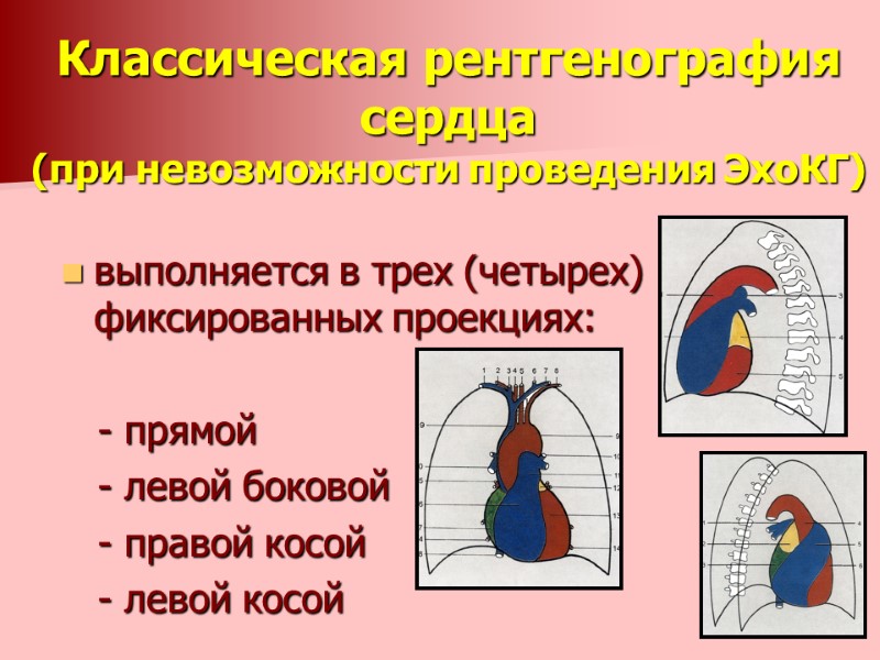 Классическая рентгенография сердца  (при невозможности проведения ЭхоКГ)  выполняется в трех (четырех) фиксированных